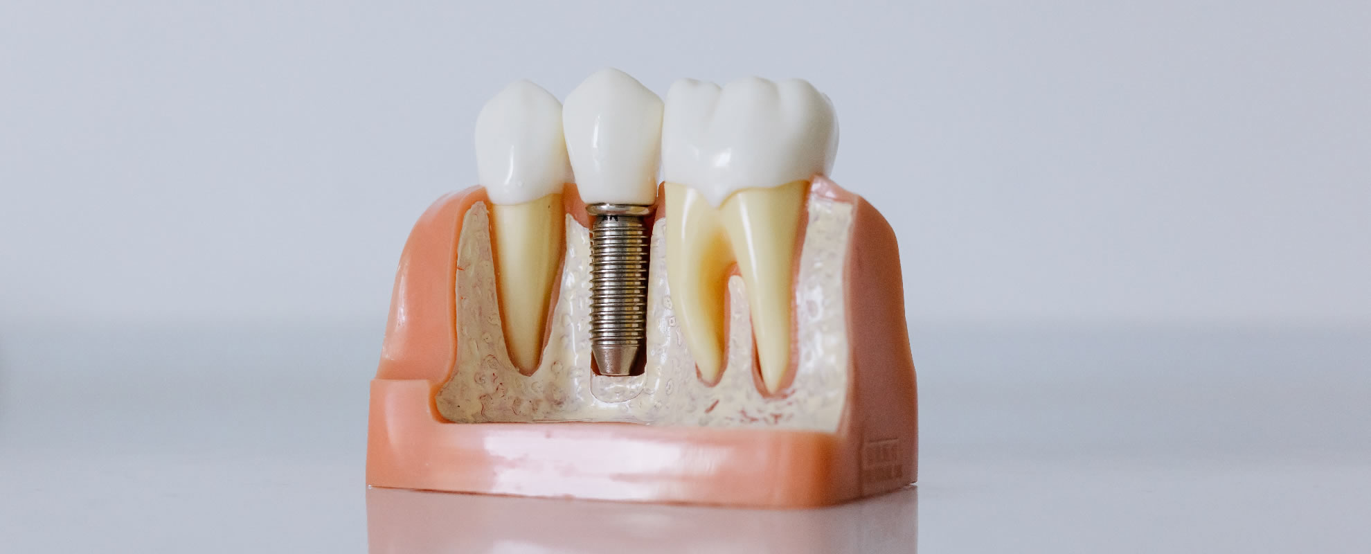 Dental Implants In Gk