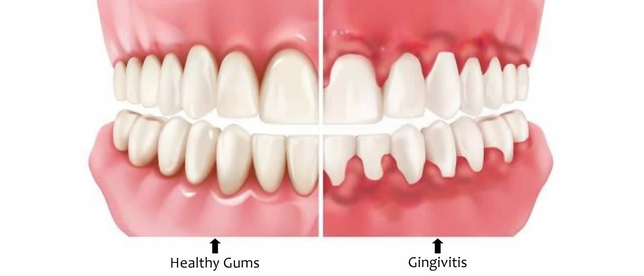 Laser Gum Treatment Pros and Cons