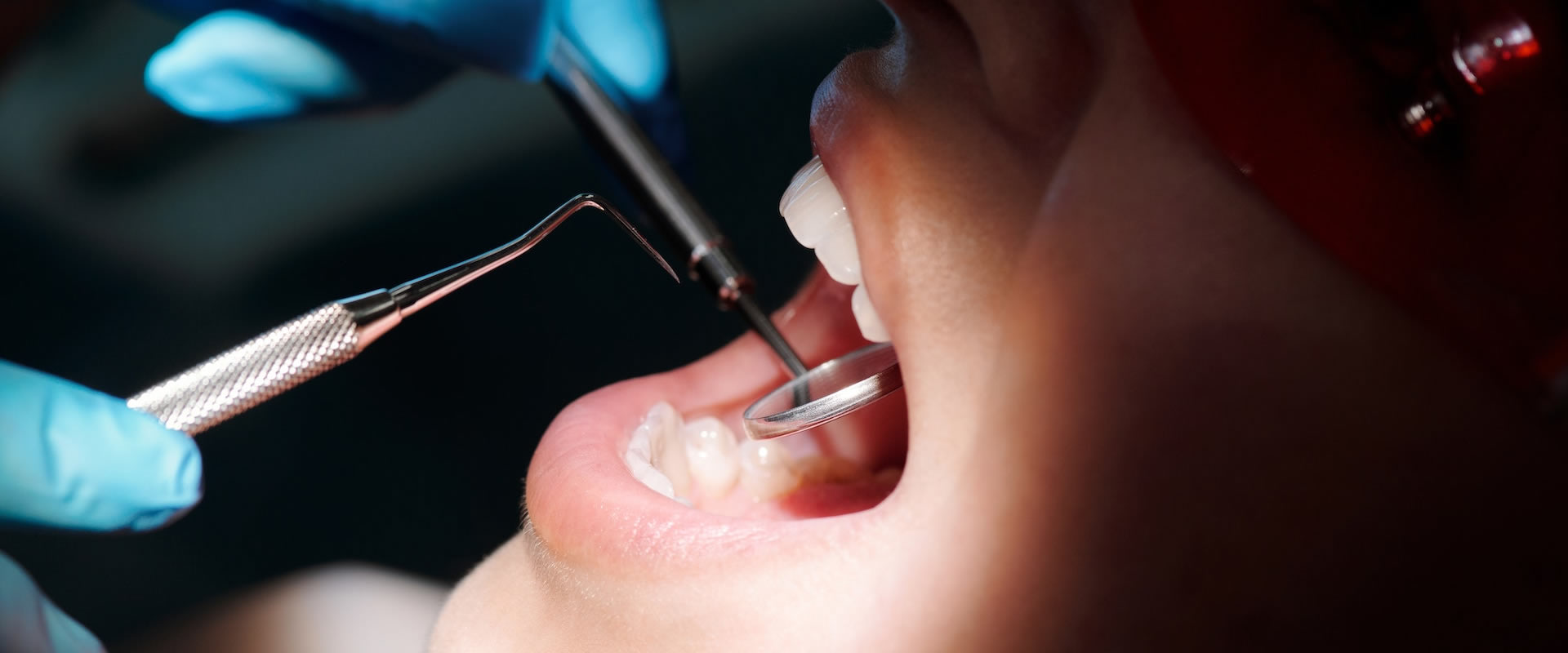 Root Canal Treatment in delhi