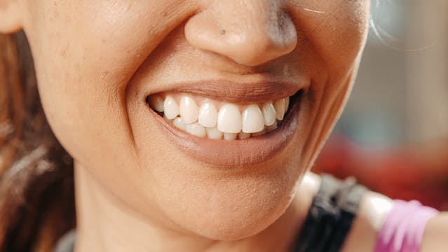 Smile Make over after