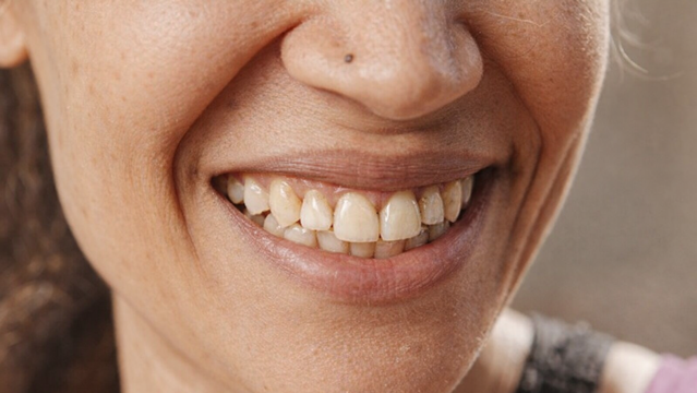 Smile Make over before