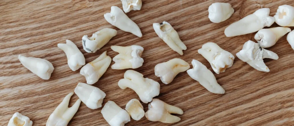 The Hidden Consequences of Losing Teeth